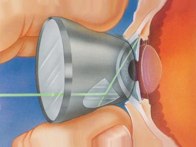 Cirugia Tratamientos Glaucoma